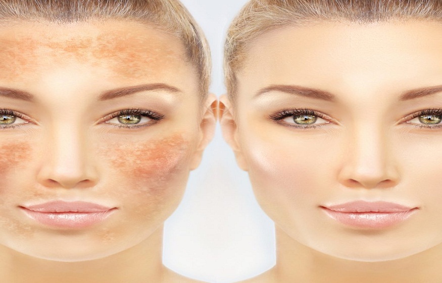 Hyperpigmentation Treatment